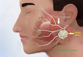 Head And Neck Tumor Removal Surgery
